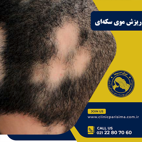ریزش موی سکه‌ای