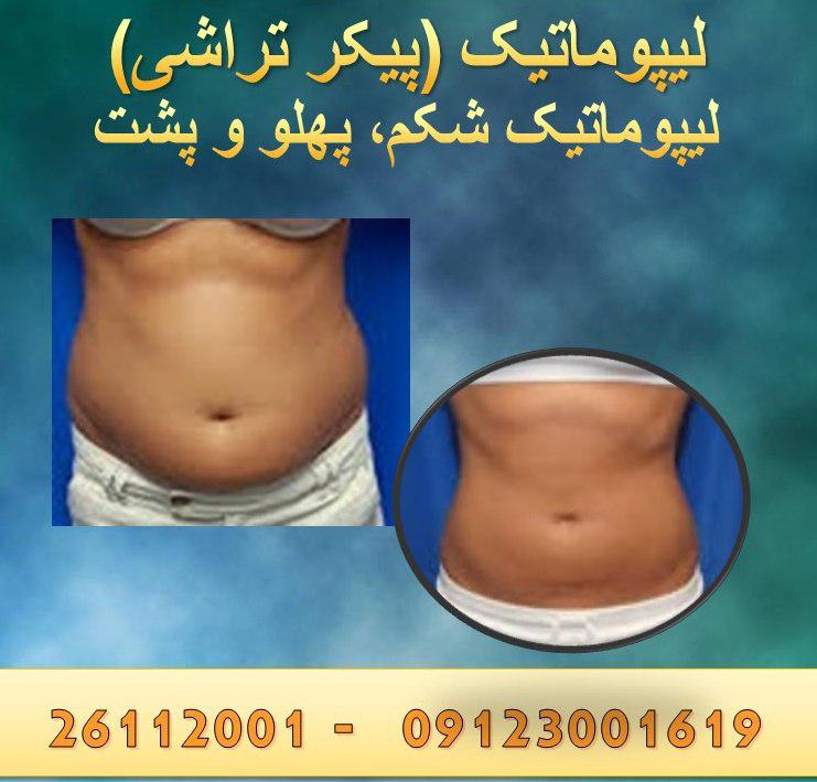 لیپوماتیک