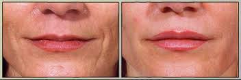 تزریق ژل - خط خنده