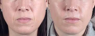 تزریق ژل - خط خنده2
