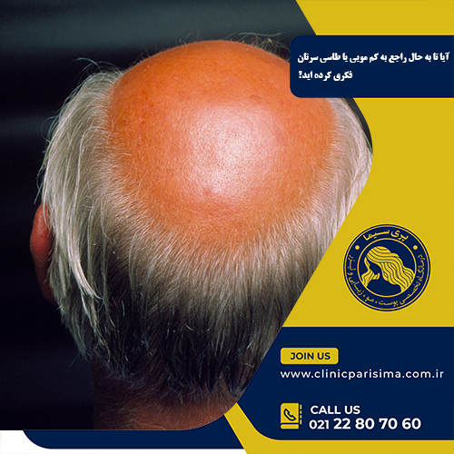 آیا تا به حال راجع به کم مویی یا طاسی سرتان فکری کرده اید؟