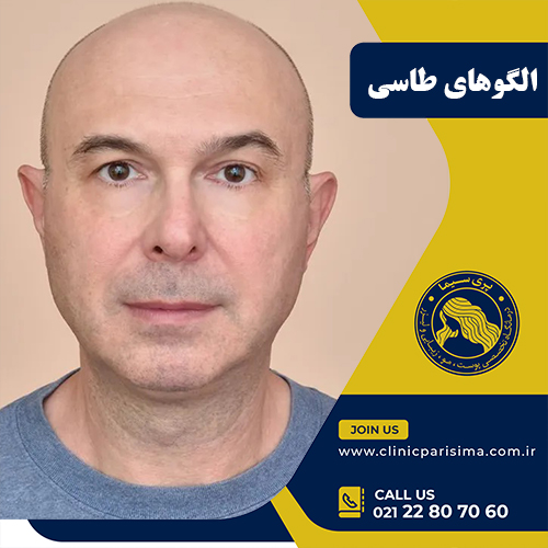 الگوهای طاسی