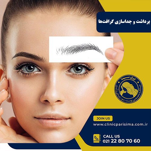 برداشت و جداسازی گرافت ها