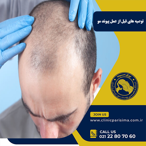 توصیه های قبل از عمل پیوند مو