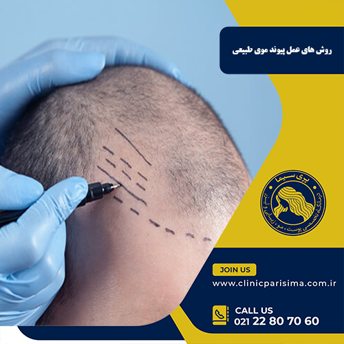 روش های عمل پیوند موی طبیعی