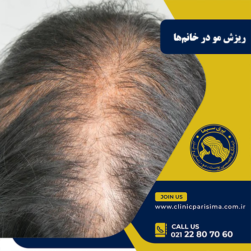 ریزش مو در خانم ها