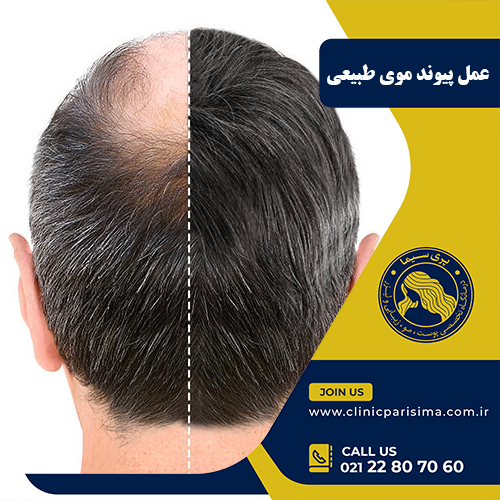 عمل پیوند موی طبیعی