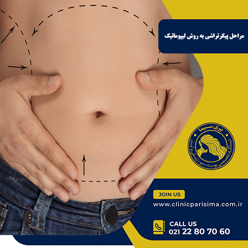 مراحل پیکرتراشی به روش لیپوماتیک