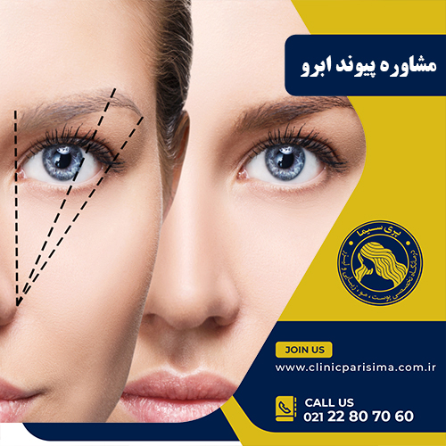 مشاوره پیوند ابرو