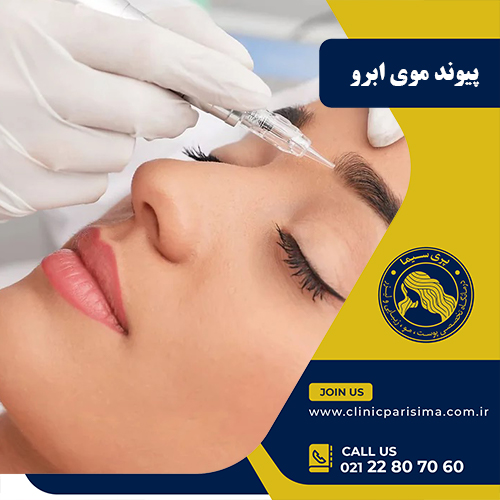 پیوند موی ابرو