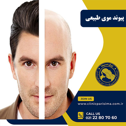 پیوند موی طبیعی