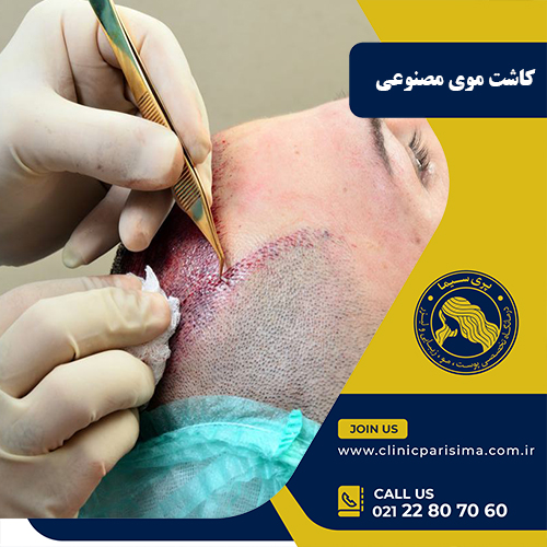 کاشت موی مصنوعی
