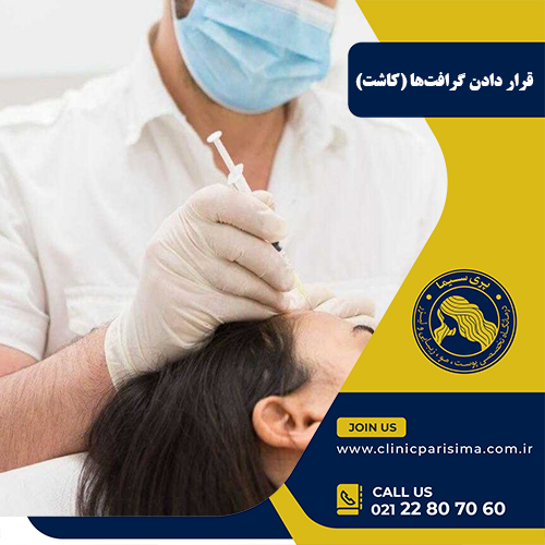 قرار دادن گرافت ها