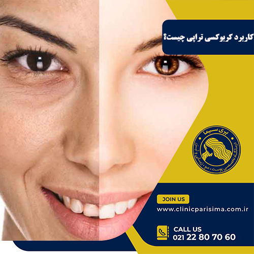 کاربرد کربوکسی تراپی - پری سیما
