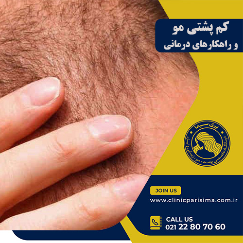 کم پشتی مو - پری سیما