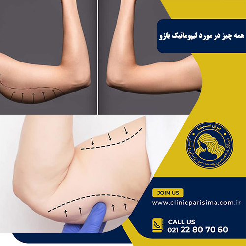 لیپوماتیک بازو - پری سیما