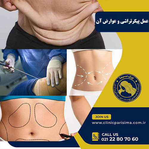 عمل پیکرتراشی - کلینیک پری سیما