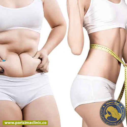 عمل پیکرتراشی - انواع روشهای پیکرتراشی
